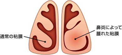 ⿐づまりの原因とメカニズム