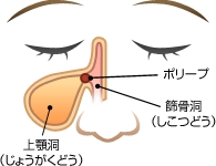 鼻たけ（ポリープ）