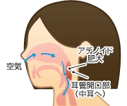 アデノイドの腫れ